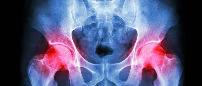 hip x-ray